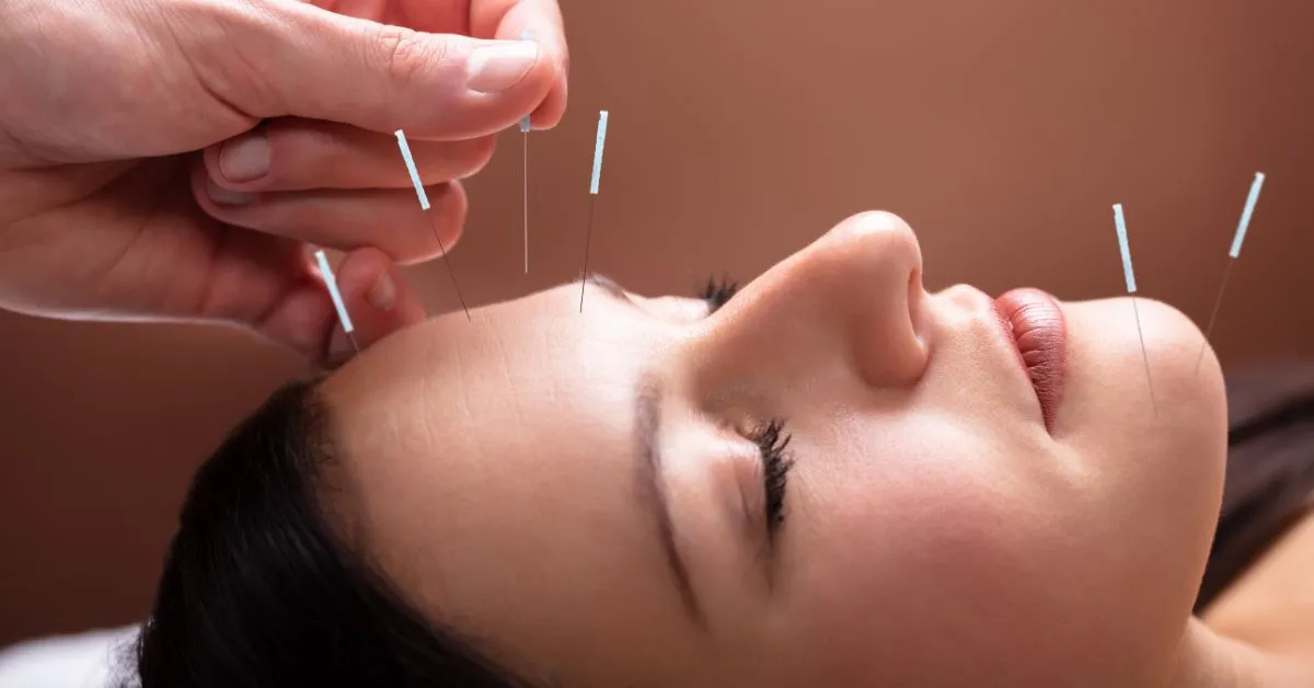 Mulher recebendo acupuntura facial com agulhas finas para alívio da dor e relaxamento.